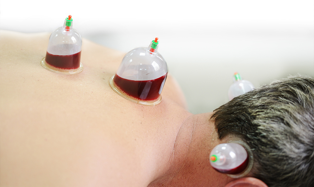 Cupping therapy